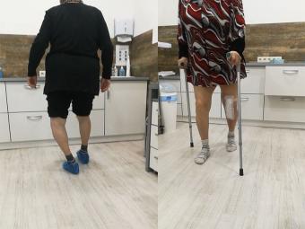 Пацієнт після протезування колінного суглоба 1 випадок